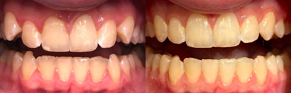 Close up photos of teeth before and after Invisalign in Schoharie