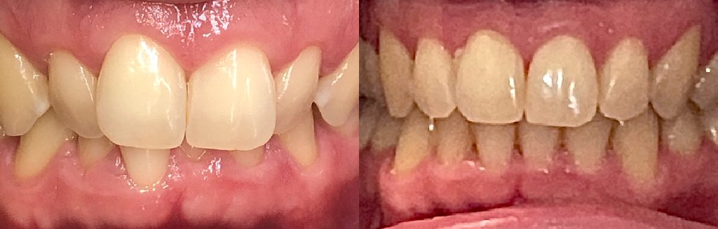 Close up photos of teeth before and after Invisalign in Schoharie