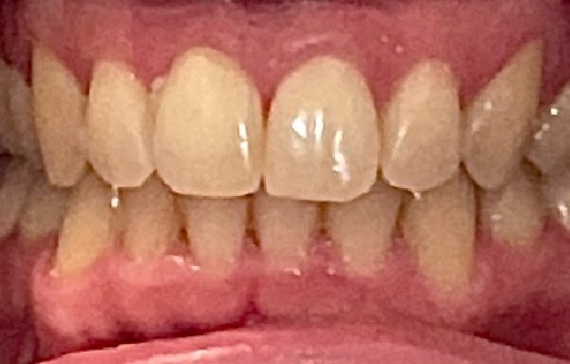 Close up of straighter teeth after Invisalign