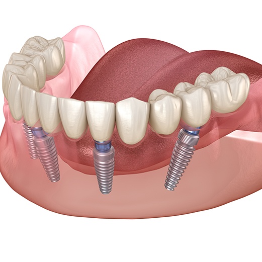 All-on-4 dental implant denture 