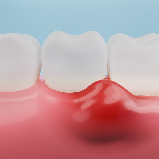 Close up of swollen gums 