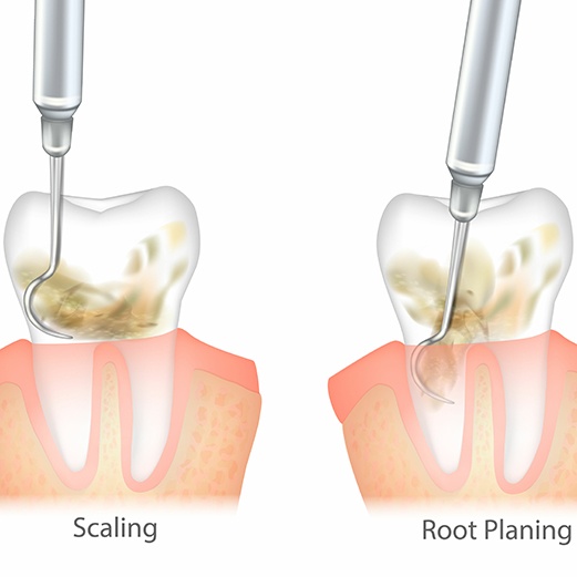 Digital illustration of scaling and root planing 