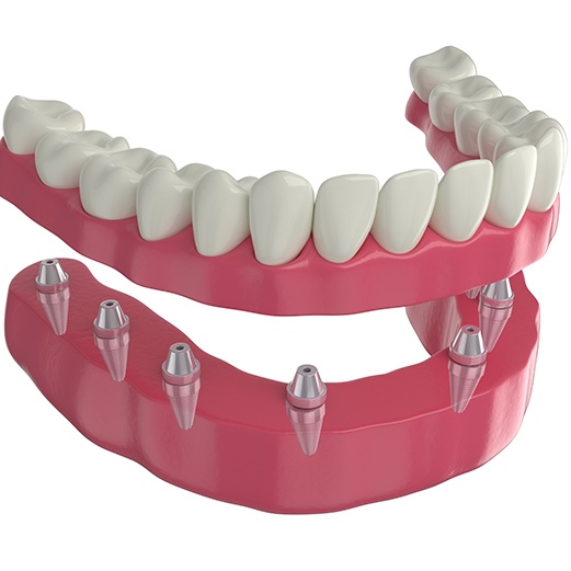 Digital rendering of implant denture 