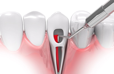 Illustration of root canal on front tooth 