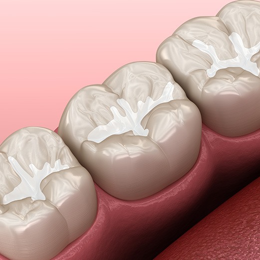 Digital illustration of a dental sealant 